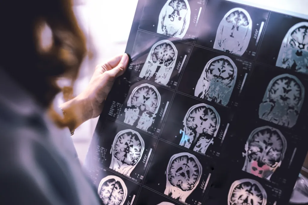 MRI scans of a dementia patient's brain showing atrophy.