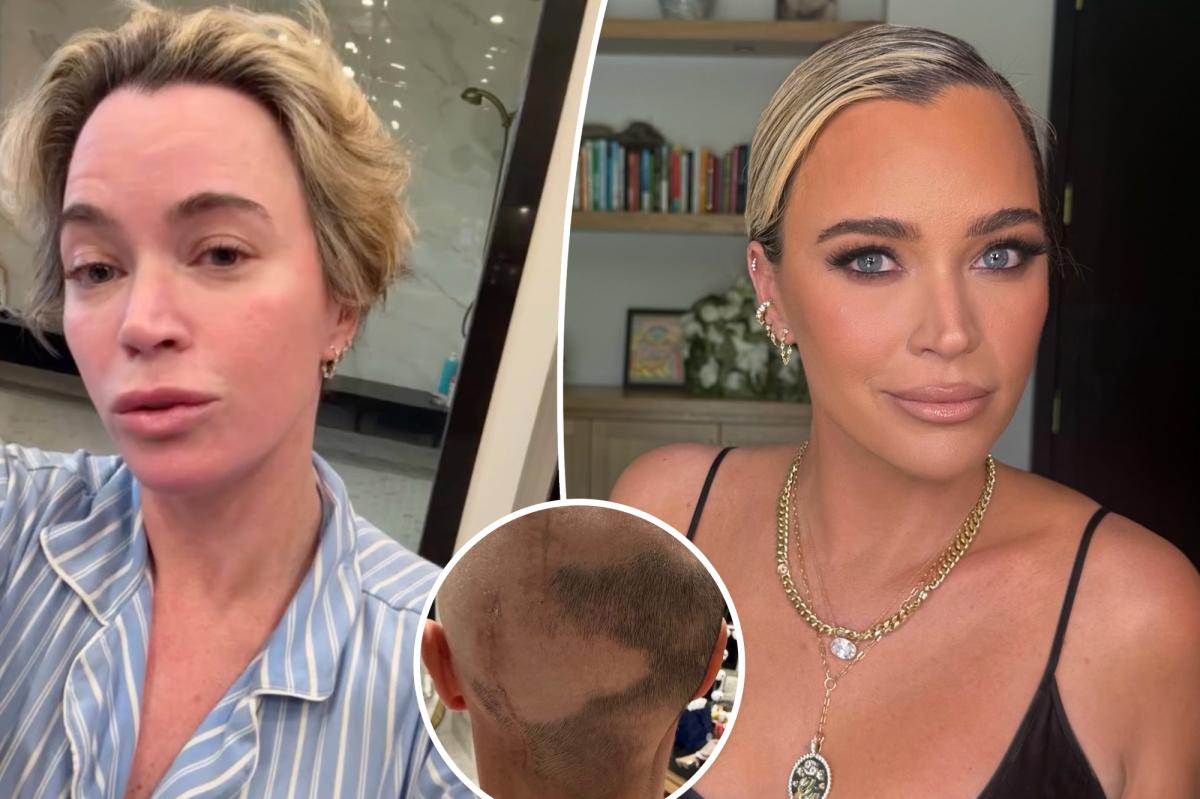 Teddi Mellencamp bravely showcases brain surgery scars as she battles stage 4 cancer: ‘Sick of the wigs’