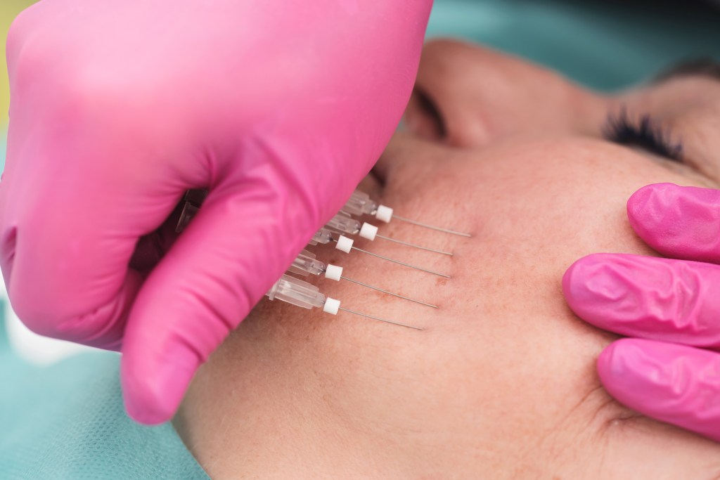 A professional using needles to inject PDO threads into a patient's face for a facelift.