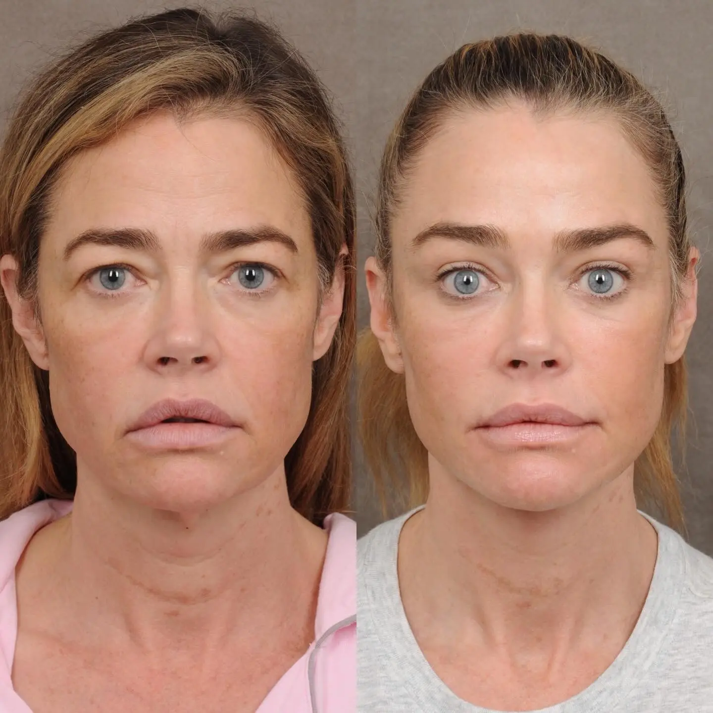 Collage of two images of Denise Richards's face, comparing her appearance before and after a facelift.