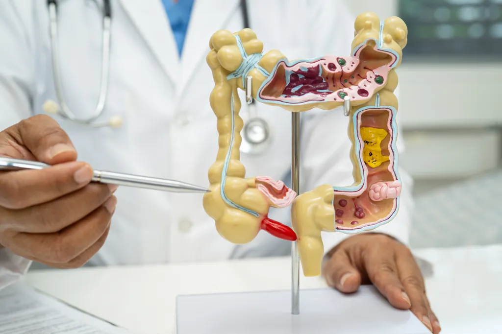 Doctor pointing at an anatomical model of the colon and appendix.