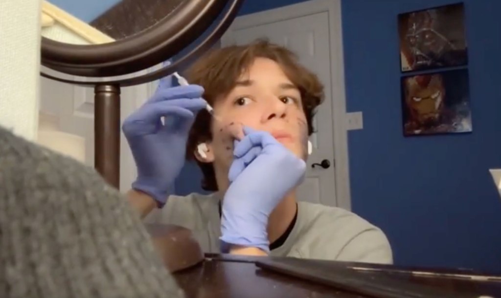 A young man in blue gloves self-injects a liquid into his cheek from a syringe, with black dots marking injection points.