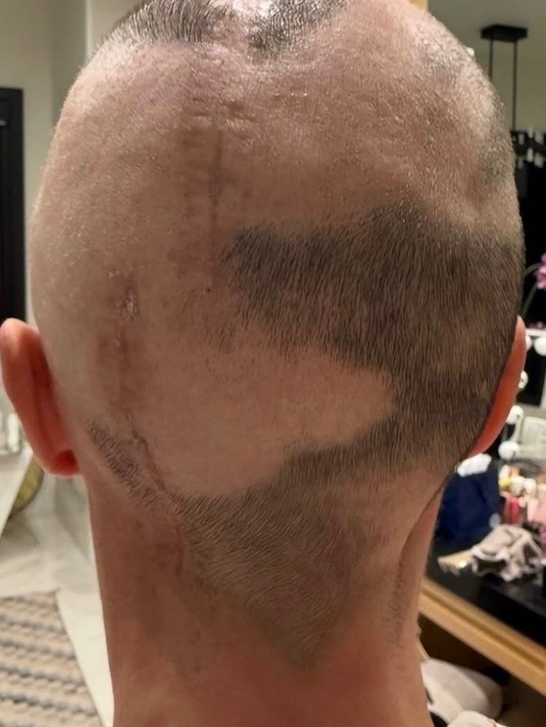 The back of a person's head with shaved hair, showing scars from brain cancer surgery.