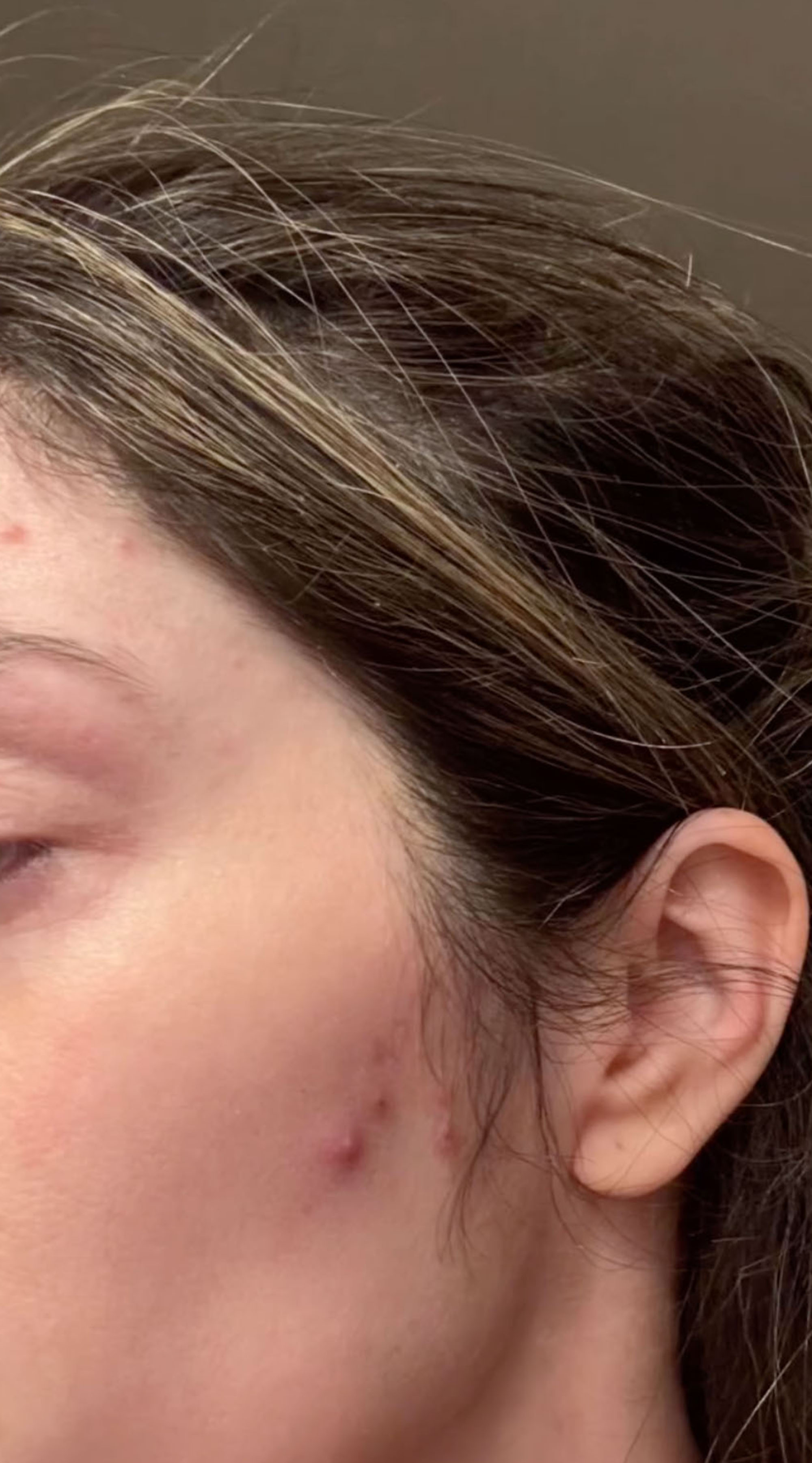 A close-up of a person's temple and ear, showing several red blemishes on the skin.