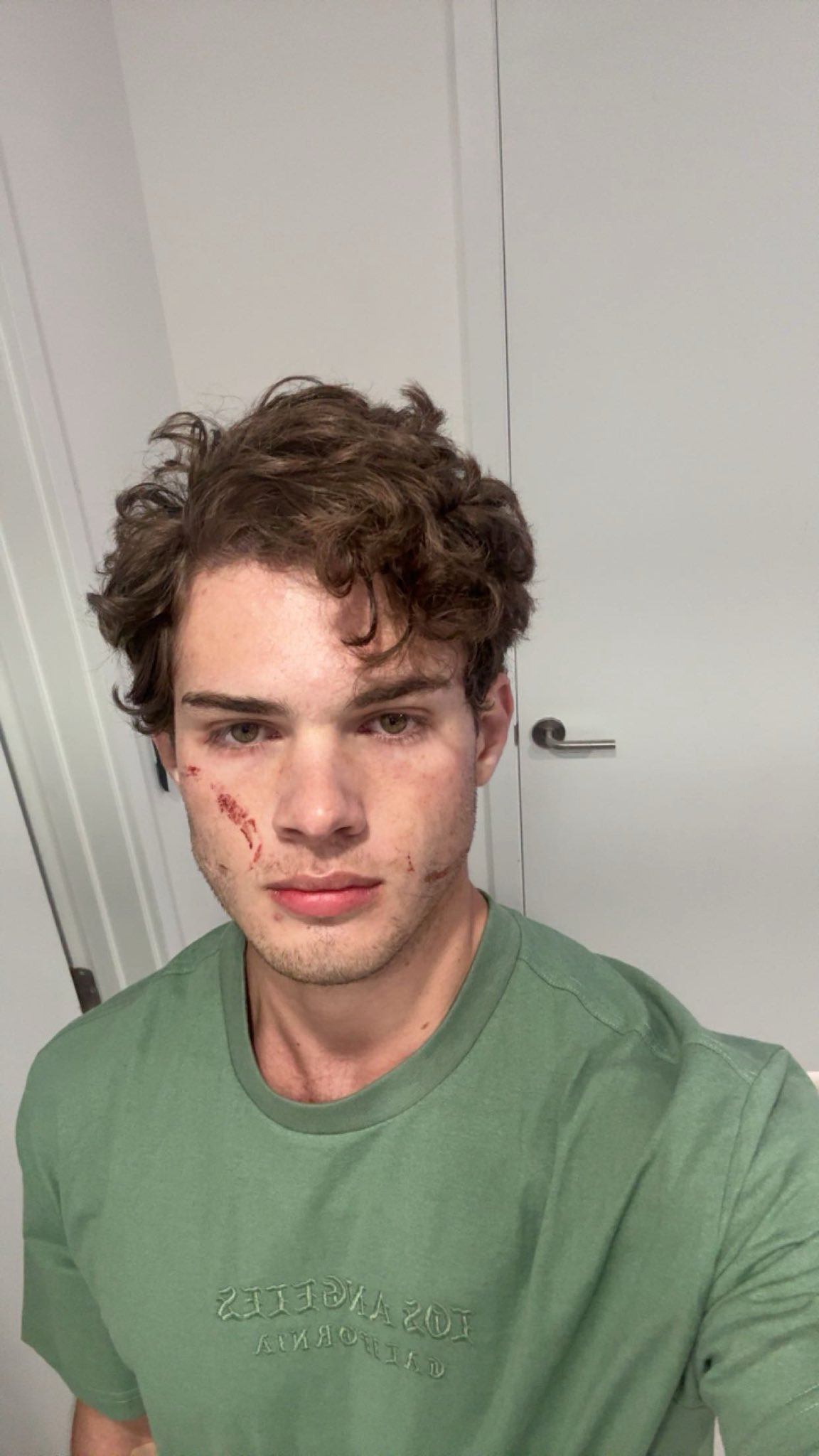 Twitch streamer Clavicular posts a selfie after overdosing, showing his face with multiple scratches.