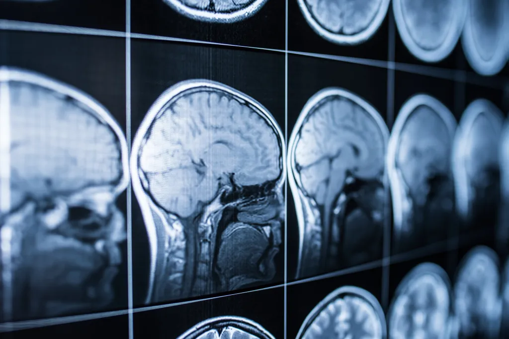 Multiple MRI scans of a human head and brain from different angles.