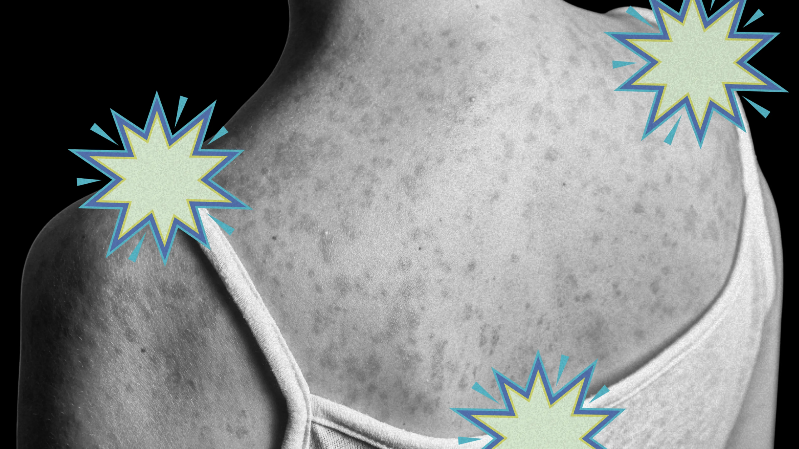 The Long-Term Measles Complication Most People Don’t Know About