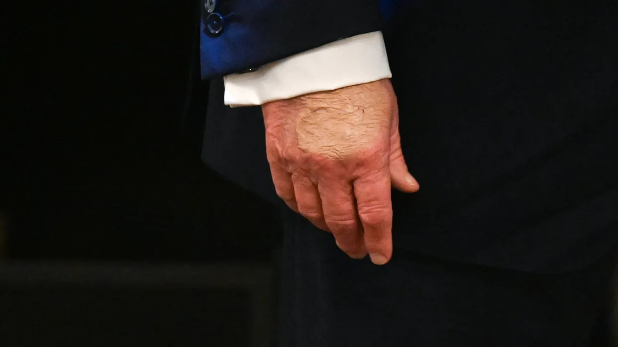 Observers point out Trump’s bruised hands during his health care affordability event