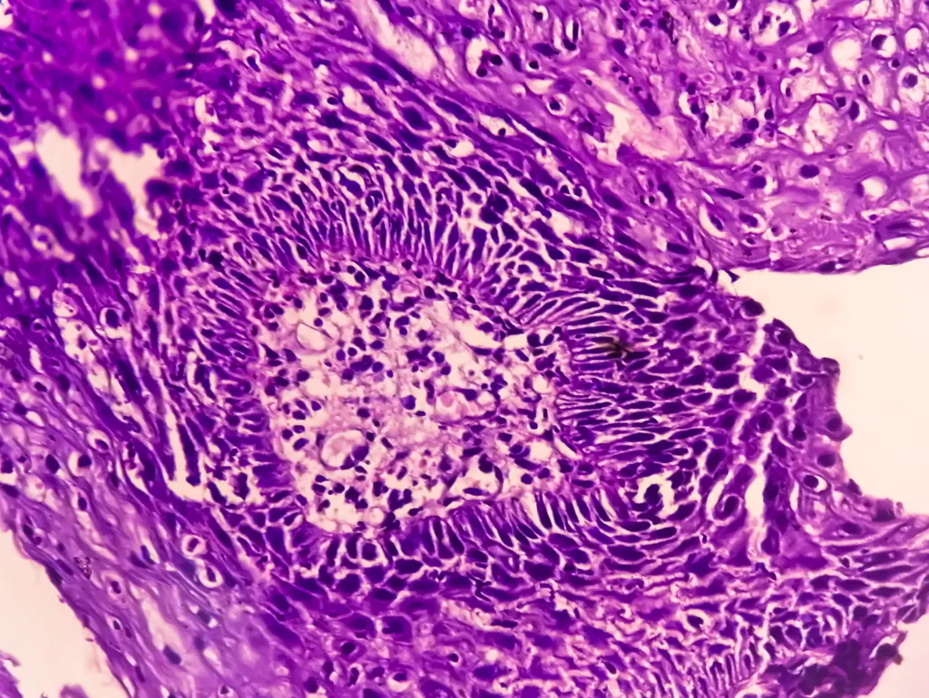 During the follow-up period, 876 people developed stomach cancer and 215 people developed esophageal adenocarcinoma, which is cancer of the tube connecting the mouth to the stomach.