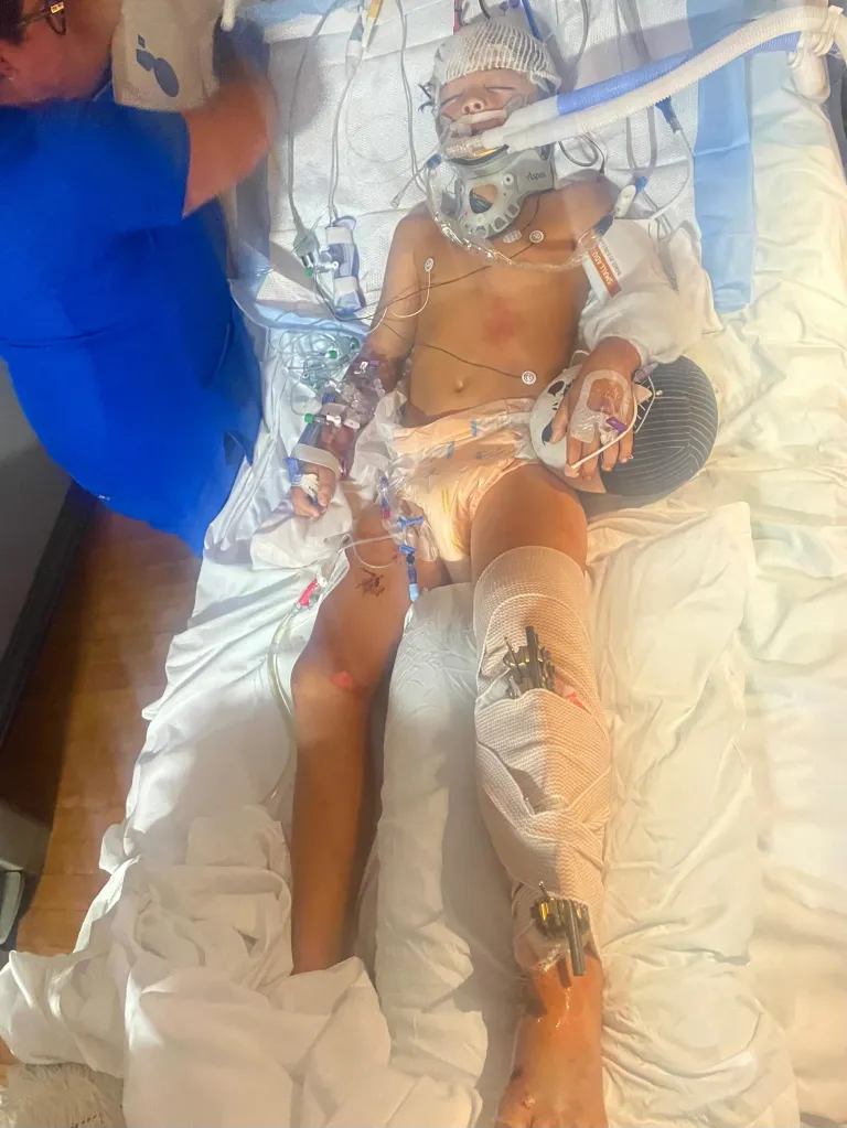 A young boy in a hospital bed with an intubation tube, neck brace, and leg bandaged with metal rods visible.