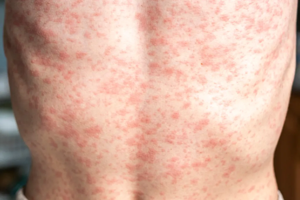 A person's back and shoulders covered in a red rash due to measles.