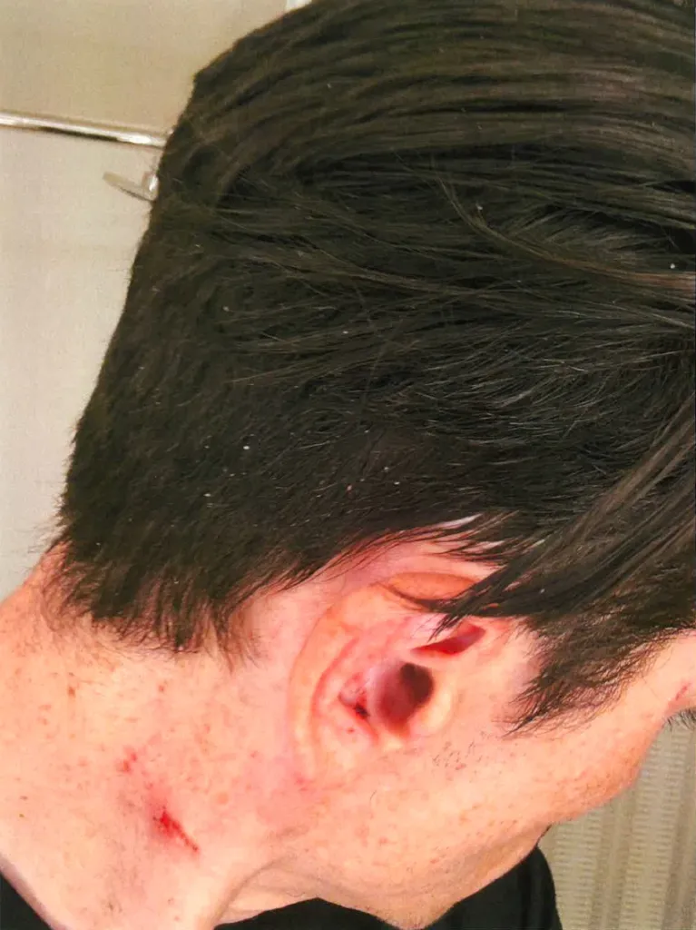 A close-up of a man's ear and neck, showing a cut on his neck and a reddish ear.