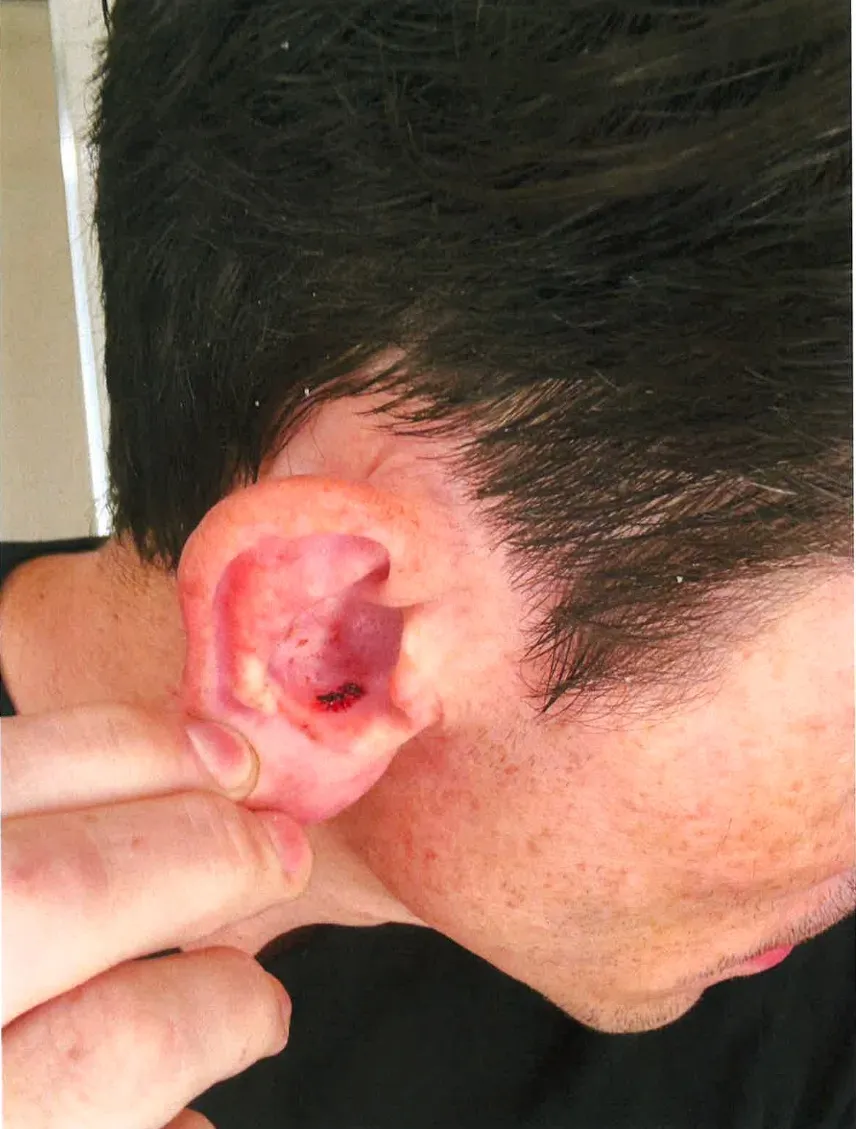 A person's ear with a small, bloody wound.