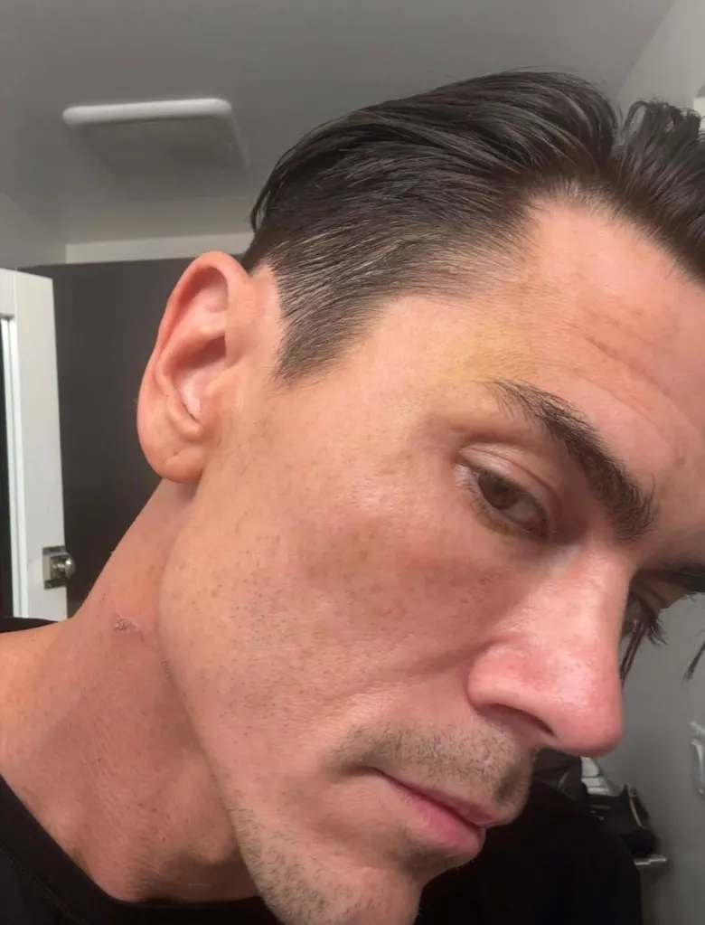 A man's bruised forehead and scratches on his neck.