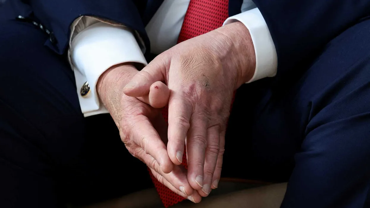 Trump sparks fresh health concerns after displaying new ‘blotch’ at G7 Summit: report