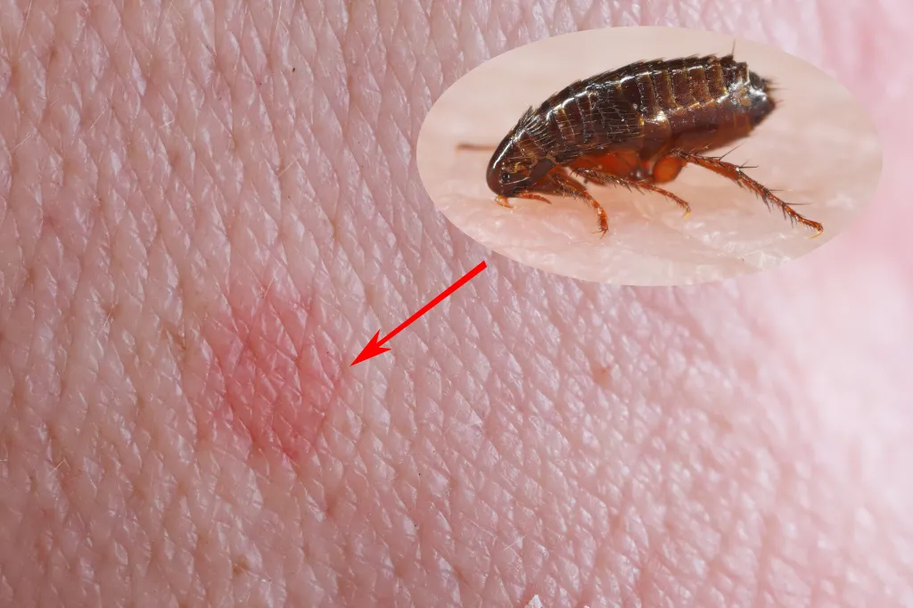 Close-up of a flea bite on human skin with inset of a flea.