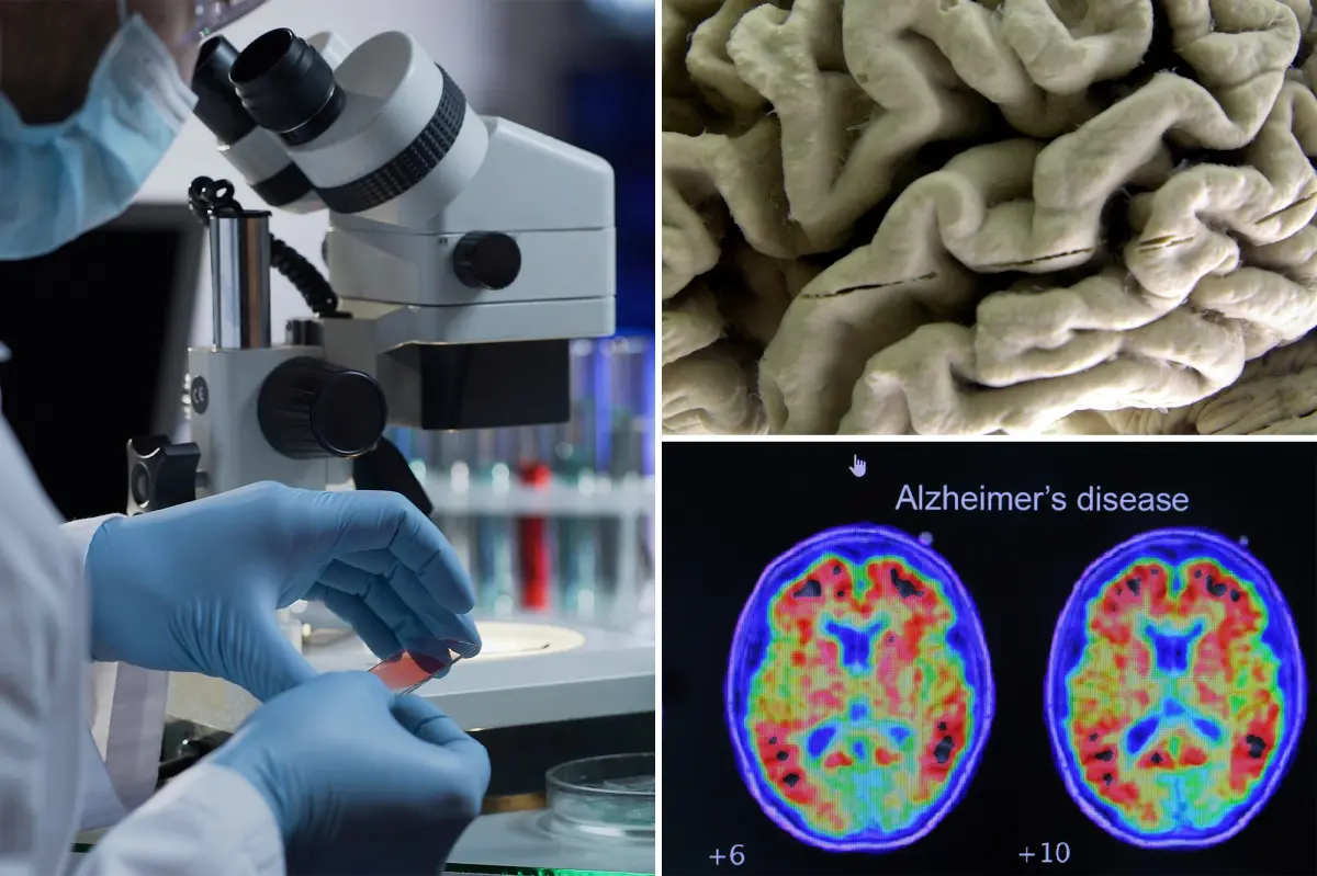 Blood test may detect Alzheimer’s risk in healthy people, study finds