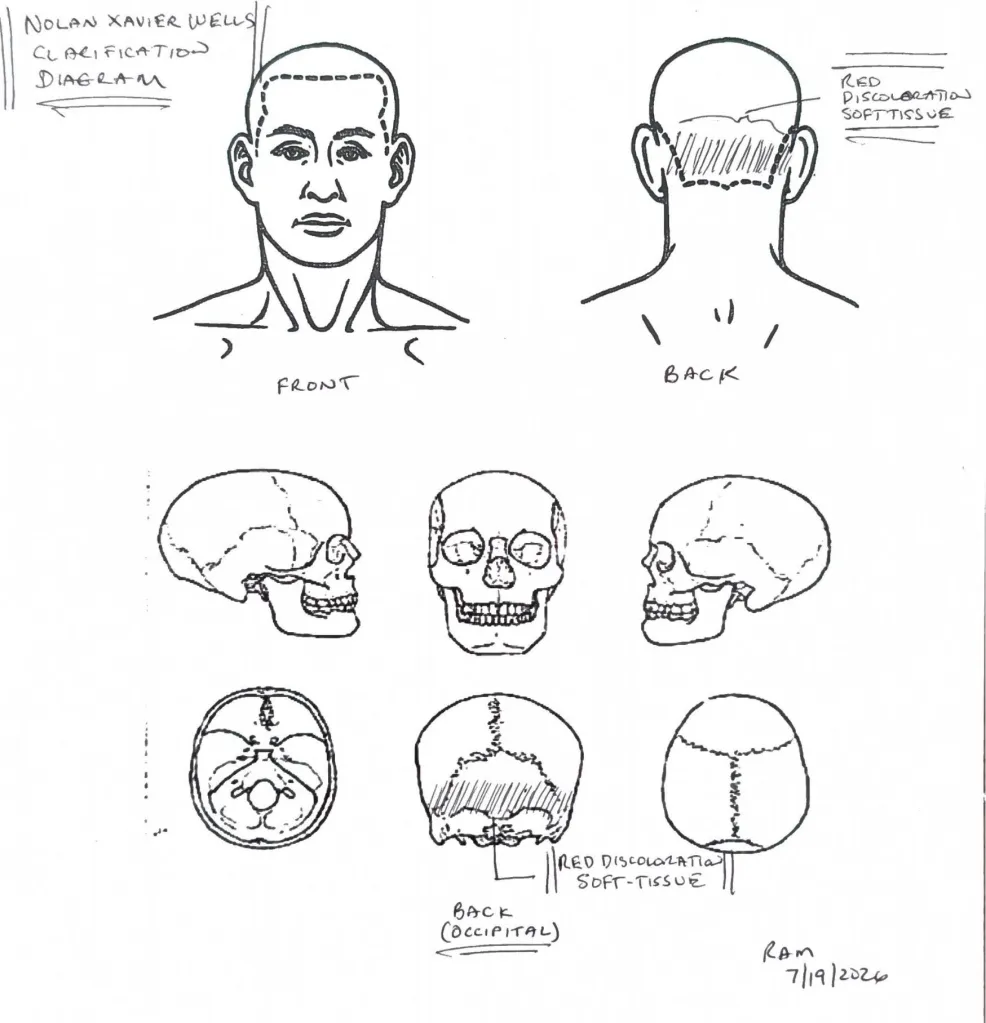 Illustration of anatomical diagrams for Nolan Xavier Wells, showing discolored soft tissue on the back of the head/occipital area.