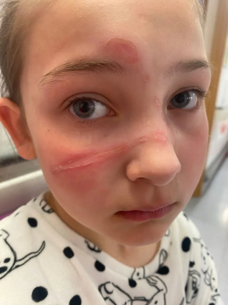 Bella, a child with severe burn injuries on her face.