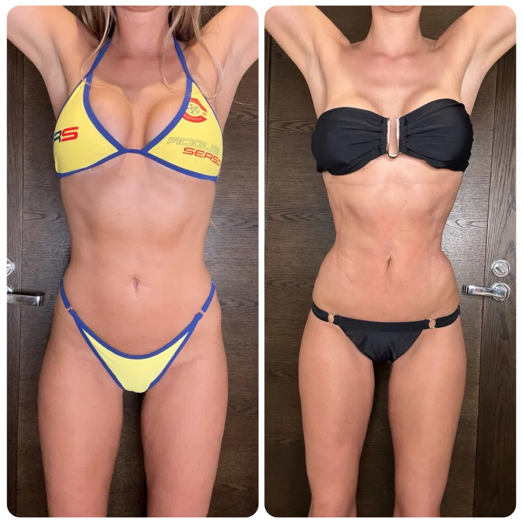 Before and after images of a woman's torso, illustrating the results of a 'rib contouring' procedure.