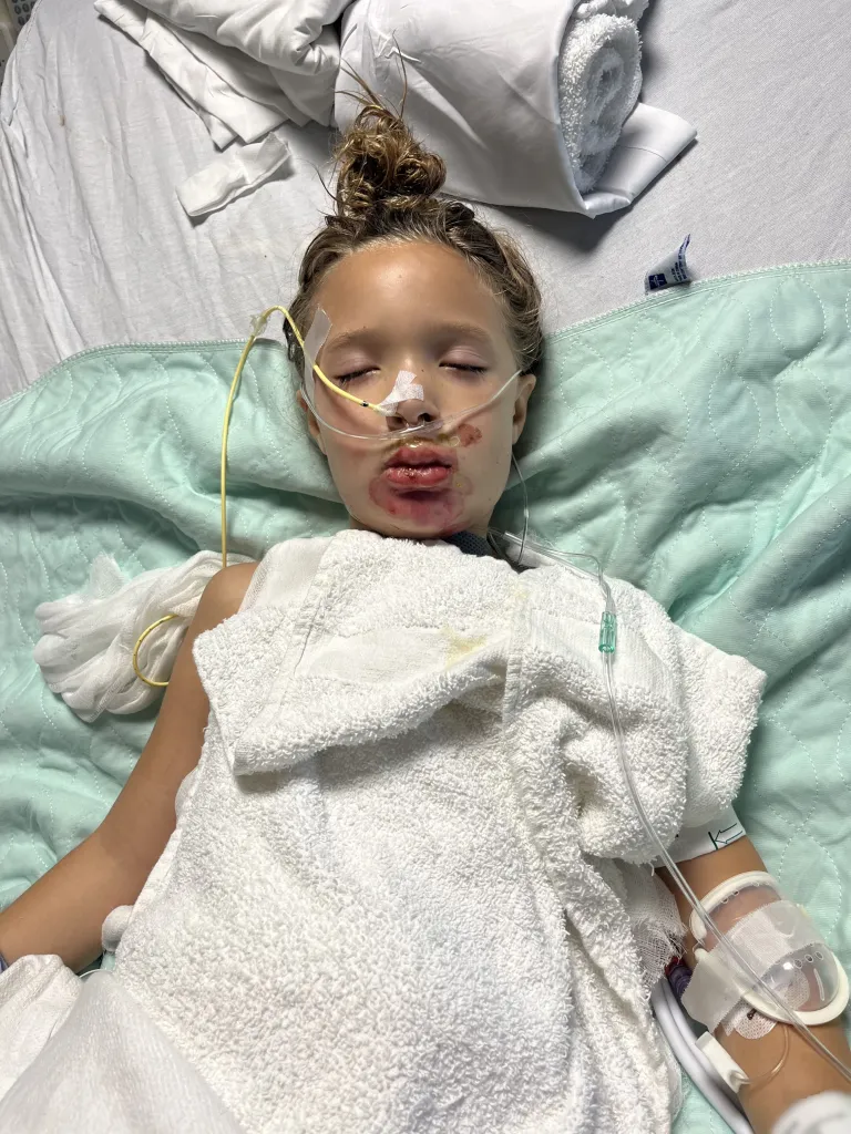 Seven-year-old Scarlett Selby in hospital with burns to her face, eyes closed, with a nasal cannula and medical tape on her face, and an IV in her arm.
