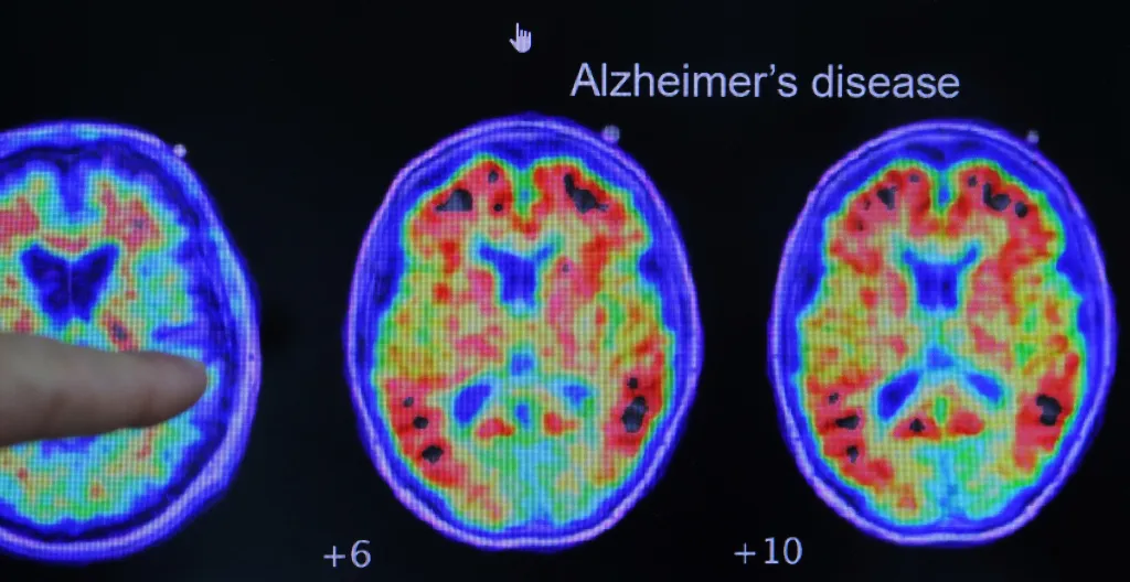 A finger points to a PET scan showing evidence of Alzheimer's disease.