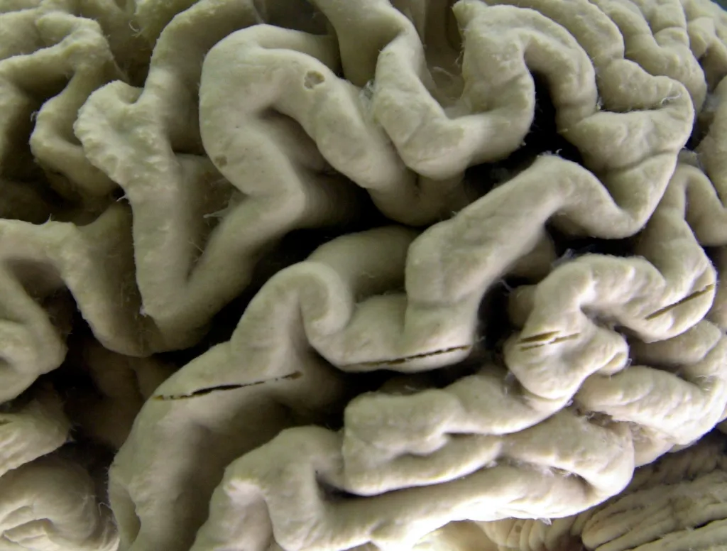 Close-up of a human brain affected by Alzheimer's disease.