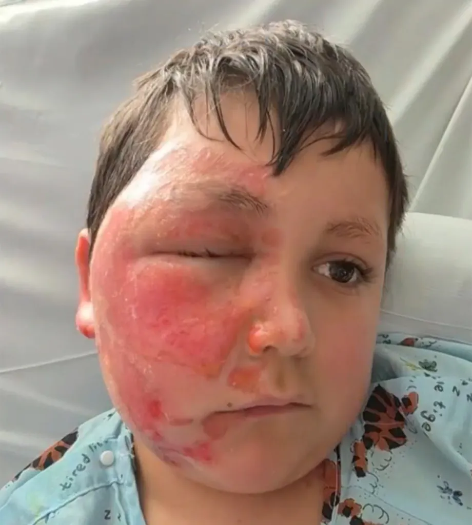 Caleb Chabolla, an Illinois boy, with burns on his face after putting a sensory toy in the microwave.