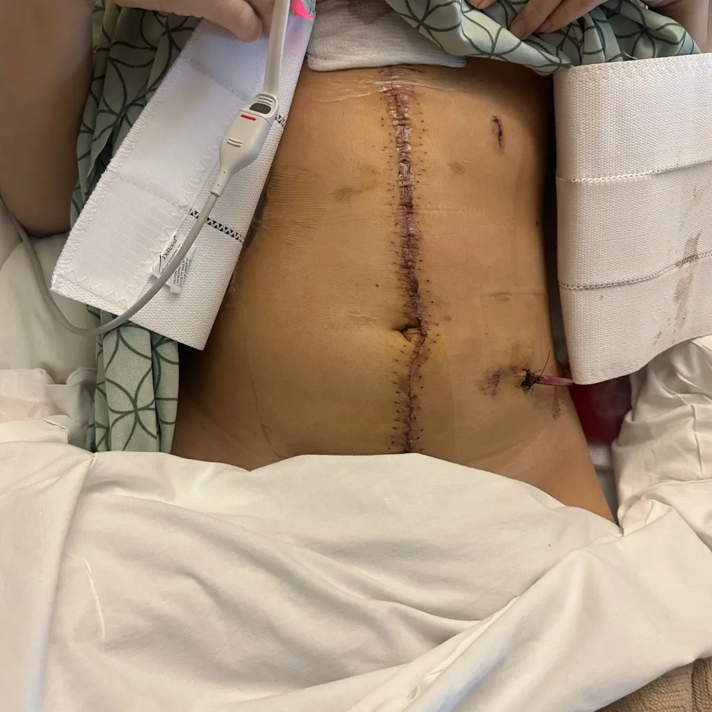 Lilly Dalton's abdomen after major liver resection surgery, showing a long incision with sutures, an external drain, and medical monitoring equipment.