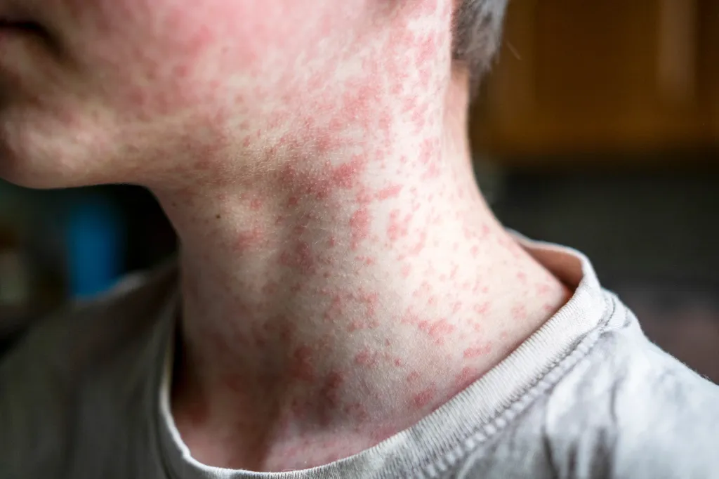 A child's skin covered in a red rash, characteristic of measles.