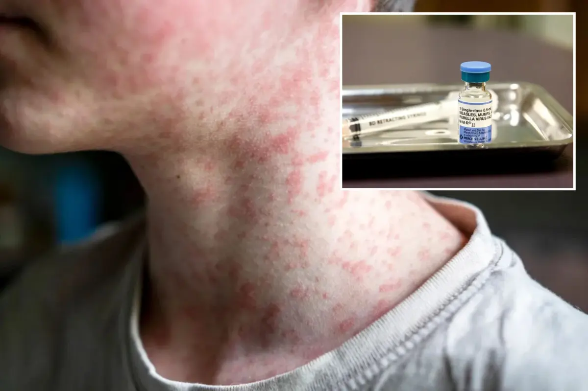 US hits most cases of ‘world’s most contagious disease’ in 35 years — and it’s only July