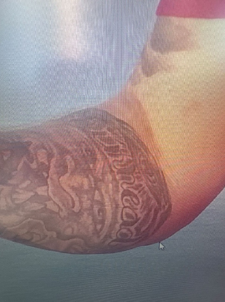 Photograph of burns on a person's skin.