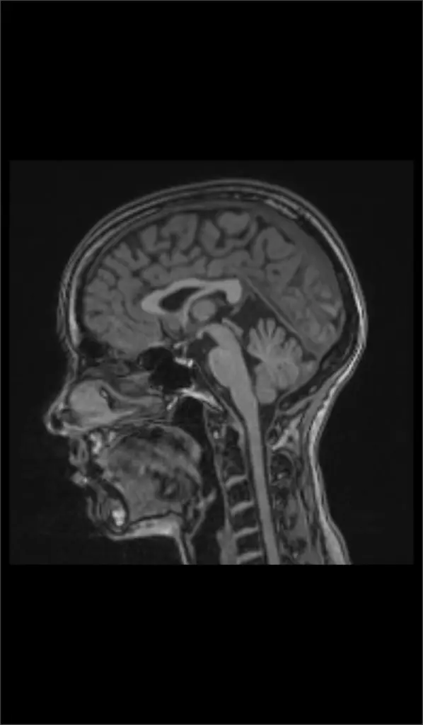 MRI scan of a human head from the side, showing the brain, skull, spinal cord and facial features