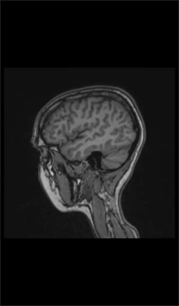 A sagittal view of a human brain scan revealing a tumor