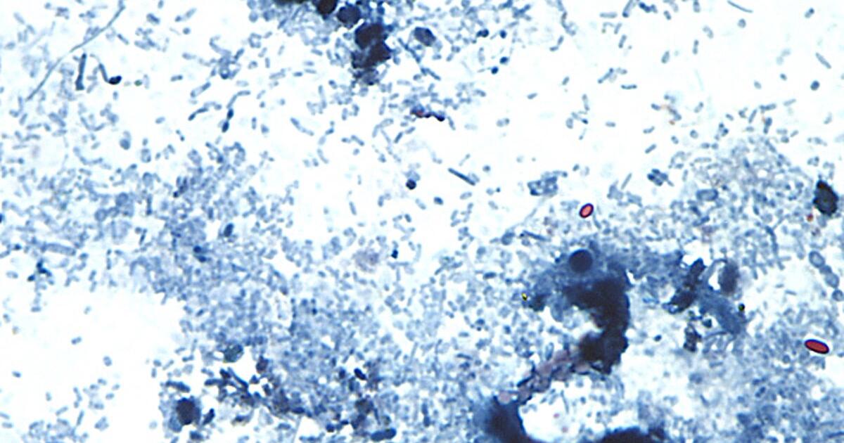 Outbreak of diarrhea-causing parasite grows to more than 1,000 cases