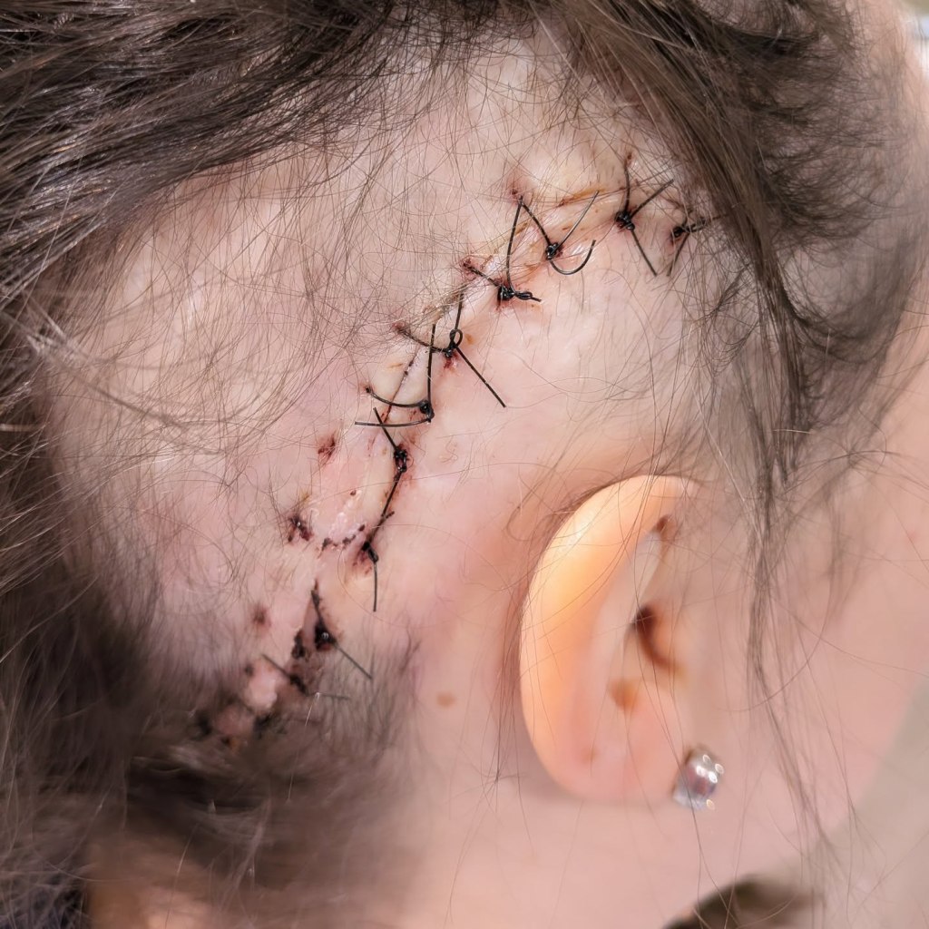 Theo Burrell's stitches from brain surgery are visible on her scalp.