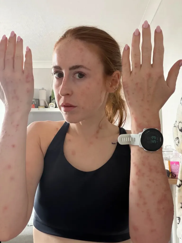 Hannah Stephenson, 31, suffered bites after staying at the Travelodge on Newmarket Road on July 26. Stephenson, of Bassingbourn, South Cambridgeshire, woke up the next day with itchy red lumps across her body and blood spots on the bedding.