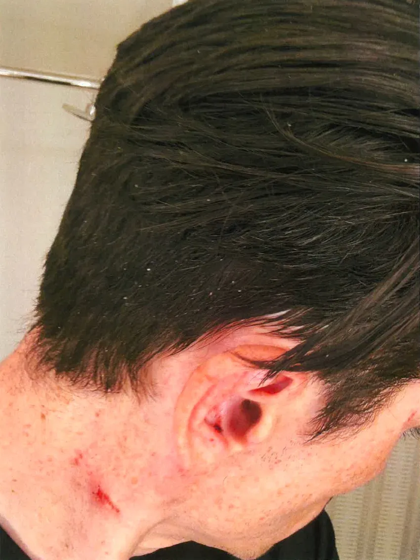 A person with dark hair, a cut on their neck, and a lacerated ear.